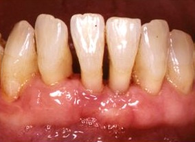 Foto de periodoncia Clínica Dental Murtra Barcelona