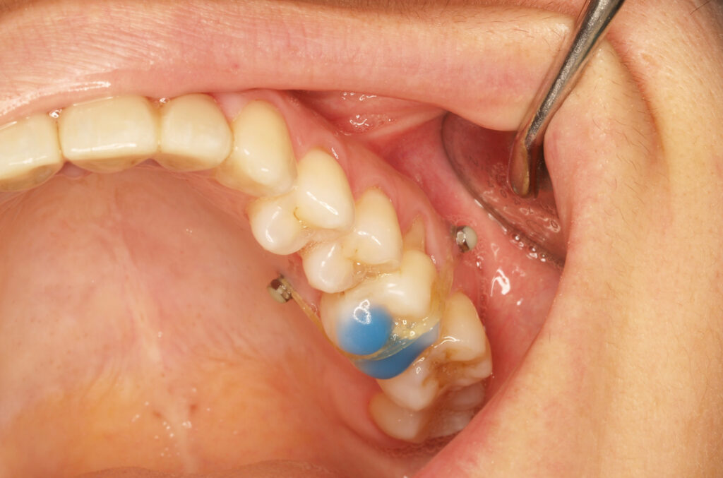 Microtornillos ortodoncia Clínica Murtra